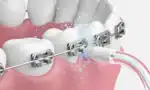 Oclean A10 Airpump Orthodontic nozzle