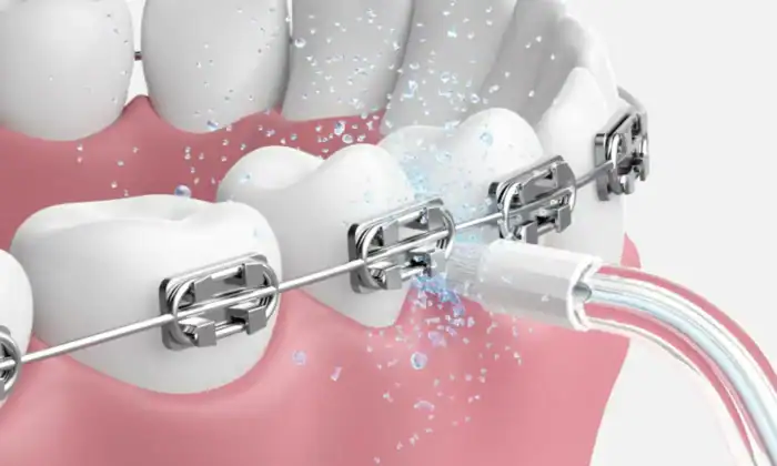 Oclean A10 Airpump Orthodontic nozzle